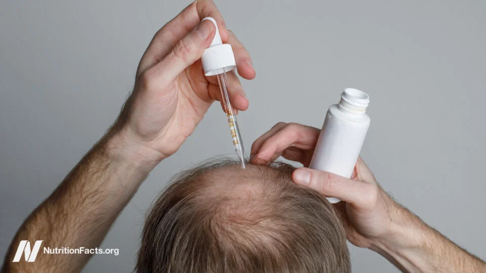 Evaluating Finasteride and Minoxidil: Efficacy and Risks in Hair Loss Treatment