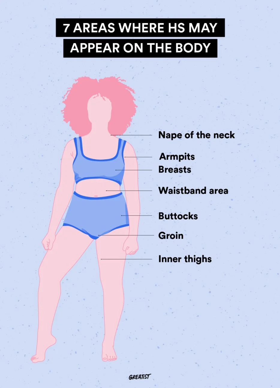 Understanding the Common Areas Affected by Hidradenitis Suppurativa