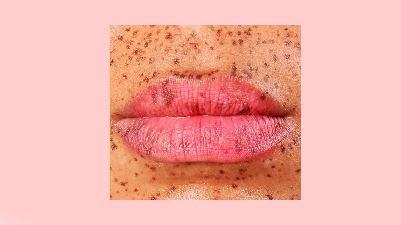 Effective Strategies for Rapid Relief from Cracked Lip Corners